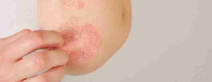syphilis rash dry skin